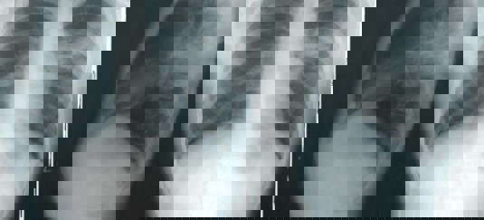 Röntgenfoto van longen